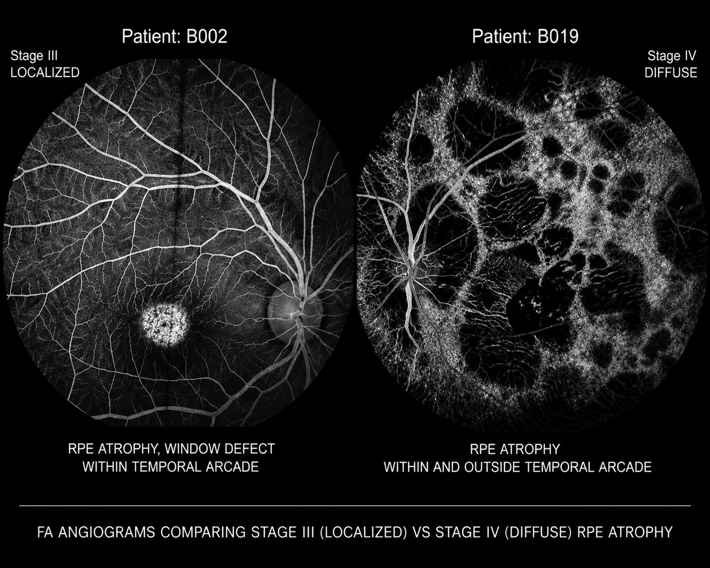 Figure 2 - Fluorescein Angiograms comparing Stage III (localized) vs Stage IV (diffuse) RPE atrophy
