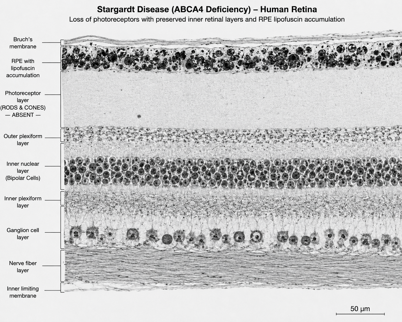 Figure C1 - Stargardt disease human retina