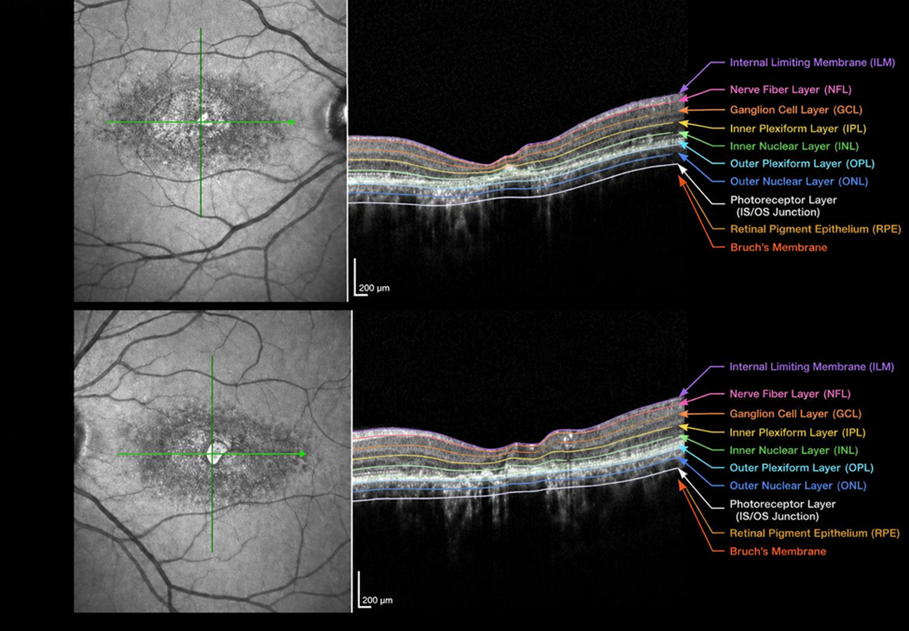 Figure C2 - Stargardt disease fundus and OCT